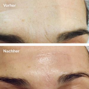 liftmeso_vorhernachher66